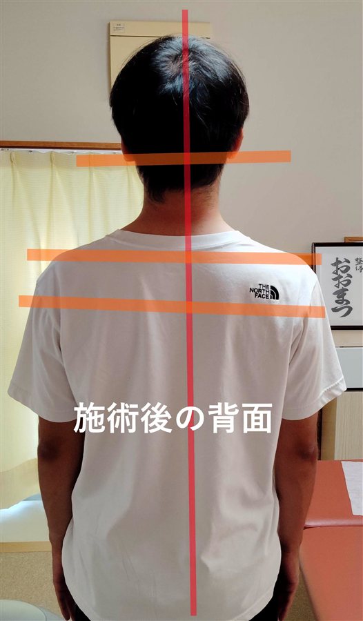 施術後の背面 姿勢検査