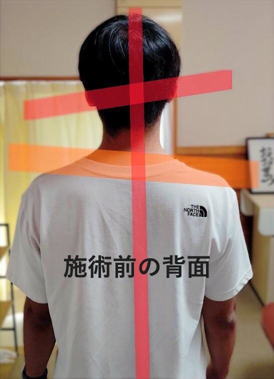 施術前の背面 姿勢検査